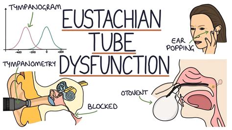 Understanding Eustachian Tube Dysfunction - YouTube