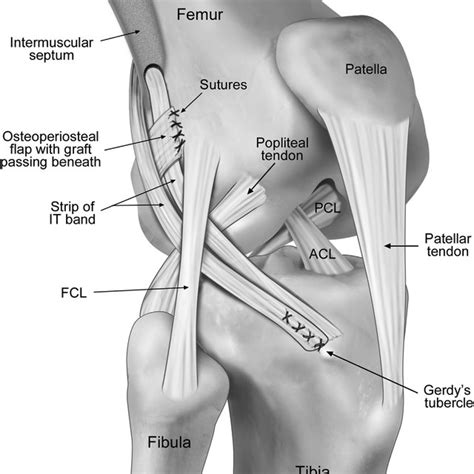 Lemaire technique. 27 (FCL, fibular collateral ligament; PFL ...