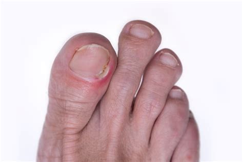 Tender Toe? Reasons Why Your Toe Hurts | Nagy Footcare