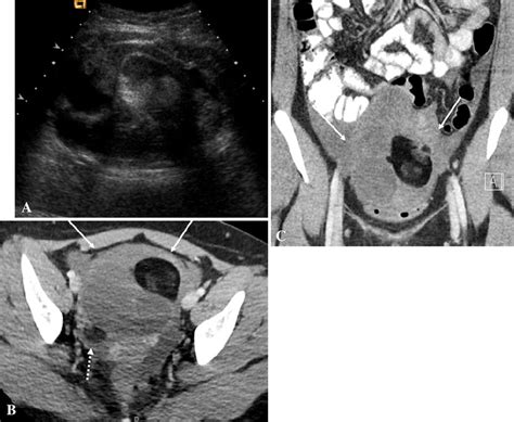 Torsion of a left ovarian mature cystic teratoma: a 16-year-old female ...