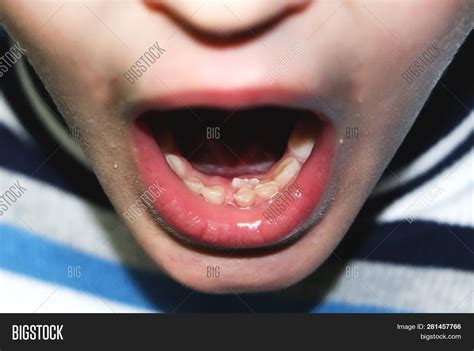 Changing Milk Teeth. Image & Photo (Free Trial) | Bigstock