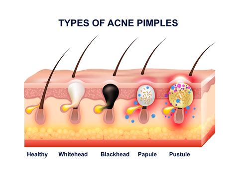 Skin Acne Types Diagram Vector Skin Problems Disease Pimples | The Best ...