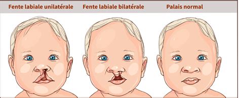 Syndrome de Kallmann : Causes, Symptômes et Traitements - Information hospitalière : Lexique et ...