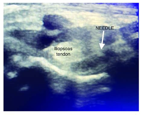 Injection technique of PENG block. | Download Scientific Diagram