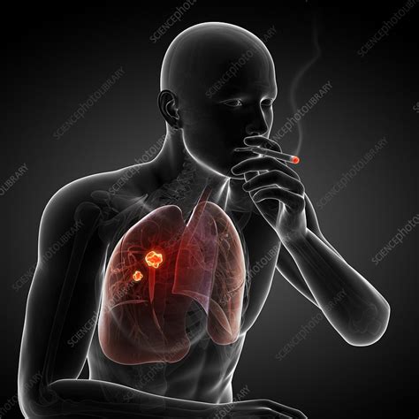 Lung cancer due to smoking, artwork - Stock Image - F007/6160 - Science ...