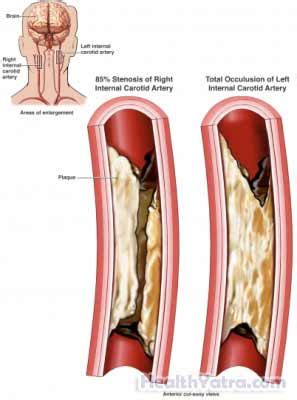 Endarterectomy Cost in India, Treatment, Hospital, Top Doctor - Updated ...