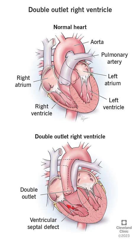 Double Outlet Right Ventricle (DORV)