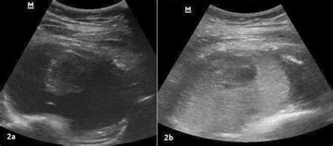 a) Ultrasound shows 22 G spinal needle within the pseudoaneurysm. b)... | Download Scientific ...