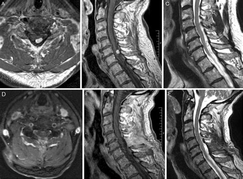 Back pain in patients with degenerative spine disease and intradural spinal tumor: what to treat ...