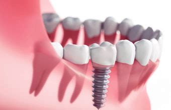 Single Tooth Implant | Dr. Cher Rich