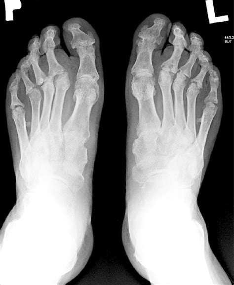 Top 91+ Wallpaper Pictures Of Psoriatic Arthritis In Feet Stunning 09/2023