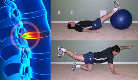 Herniated Disc Exercises: Easy and Simple Moves for Pain Relief