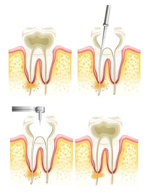 What is an Endodontist & Should You See One?