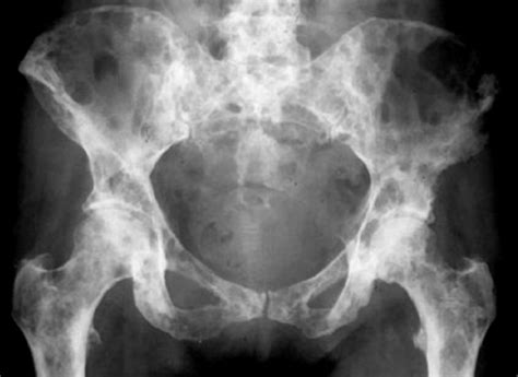 Bone metastasis | Russian Federation| PDF | PPT| Case Reports | Symptoms | Treatment