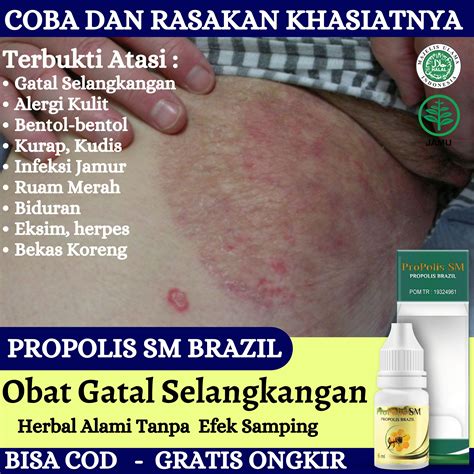 Obat gatal selangkangan alergi kulit bentol kurap kudis infeksi jamur ...