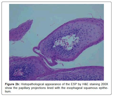 2Esophageal Squamous Papilloma in a Pediatric Patient | OMICS International