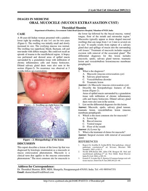 (PDF) Oral mucocele (mucous extravasation cyst)