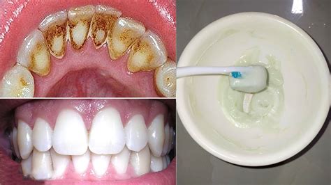 How to Remove Dental Plaque In 2 Minutes With Just These 3 Natural Ingredients - YouTube