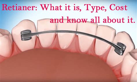 Retainer: What is It, Types, Cost, Benefits, drawback you must know ...