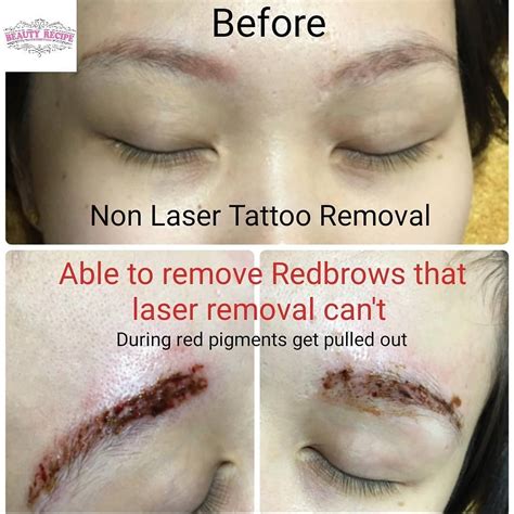 Can Semi Permanent Makeup Be Removed | Saubhaya Makeup