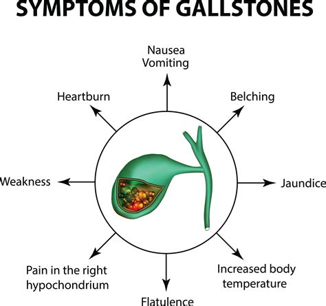 Gallstones | Christina Ong- Paediatric & Gastroenterology Clinic