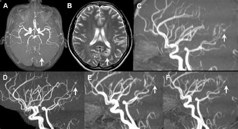 Brain Aneurysm Mri : 4 Intracranial Aneurysms Radiology Key - A brain aneurysm can result from a ...