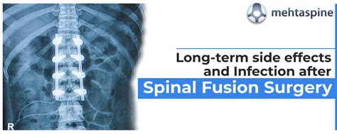 Long-term side effects and Infection after Spinal Fusion Surgery