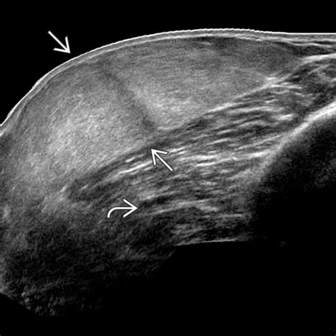 Neck Lipoma Ultrasound Images Free - Infoupdate.org