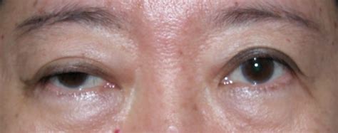 Right Eyelid Ptosis - Specialist Eye & Eyelids Clinic