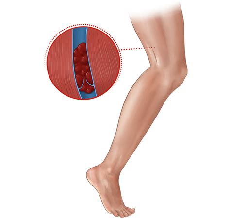 Deep Vein Thrombosis | Penumbra Patient Condition