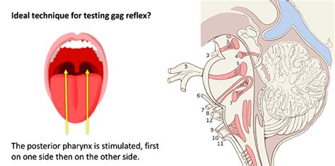 PulmCrit - Le réflexe nauséeux devrait't être testé chez des patients vivants | The Bay