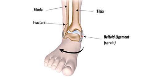 Eversion Ankle Sprain | Medial Ankle Sprain - Sportsinjuryclinic.net