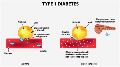 Type 1 Diabetes: Symptom, Causes, Diagnosis & Treatment » How To Relief