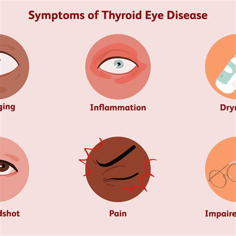 Underactive Thyroid Symptoms Eye Problems - Infoupdate.org