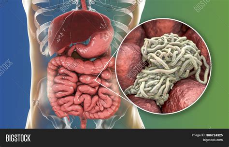 Parasitic Worms Human Image & Photo (Free Trial) | Bigstock