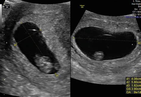 First-Trimester Ultrasound: Guidelines | Radiology Key