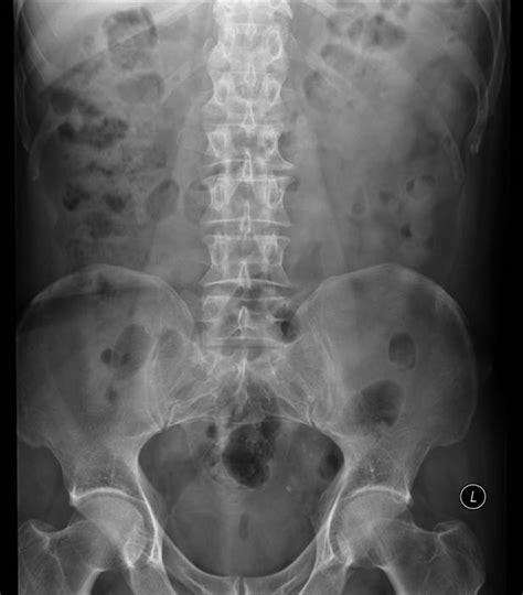 Bowel Gas – RCEMLearning India