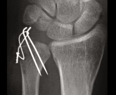 Ulnar Styloid Fracture: Causes, Symptoms & Treatment