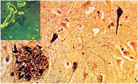 Histological lesions in Alzheimer's disease. Neurofibrillary tangles,... | Download Scientific ...