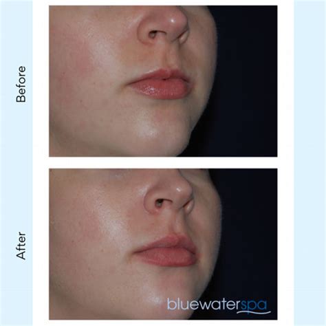 Lip Flip Botox Before And After Photos - Infoupdate.org