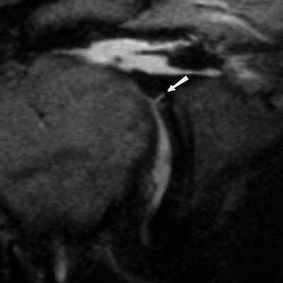 MRI Musculo-Skeletal Section: Signs of SLAP lesions.