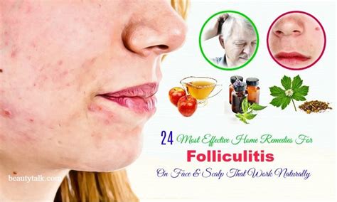 24 Most Effective Home Remedies For Folliculitis On Face & Scalp