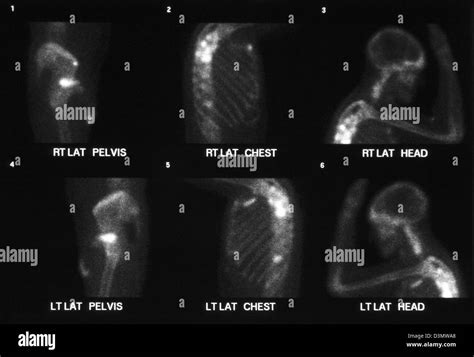 Bone scan for cancer showing multiple metastases to the shoulder, ribs, pelvis, humerus, femur ...