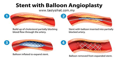 Kisah Sakit Jantung: Doktor Terkejut Hanya 1 Spring Sahaja Perlu ...