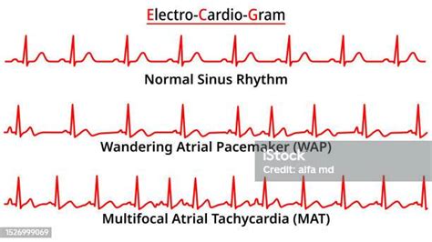 Set Of Ecg Common Abnormalities Wandering Atrial Pacemaker Stock Illustration - Download Image ...