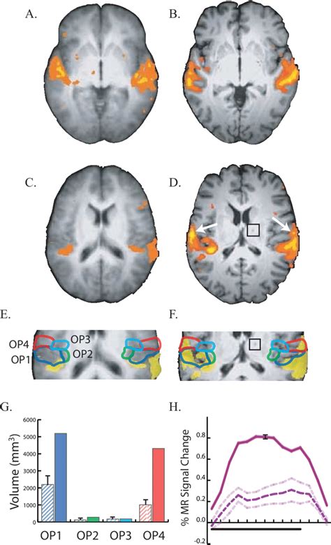 Responses to auditory stimulation in controls (A, C, E) and the patient... | Download Scientific ...