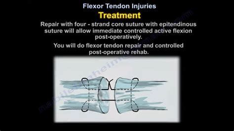 Flexor Tendon Injuries Treatment — OrthopaedicPrinciples.com