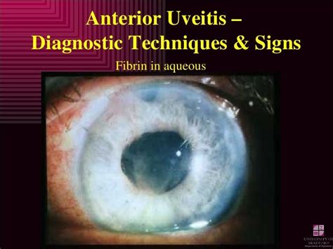 Anterior Uveitis