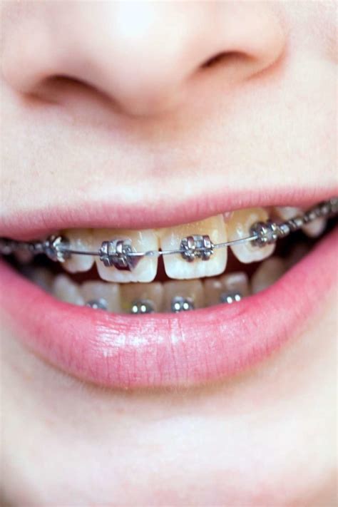 Do braces hurt? What to expect when you get braces