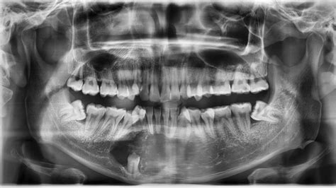 Dentigerous Cyst: What Is It? | District Dentistry